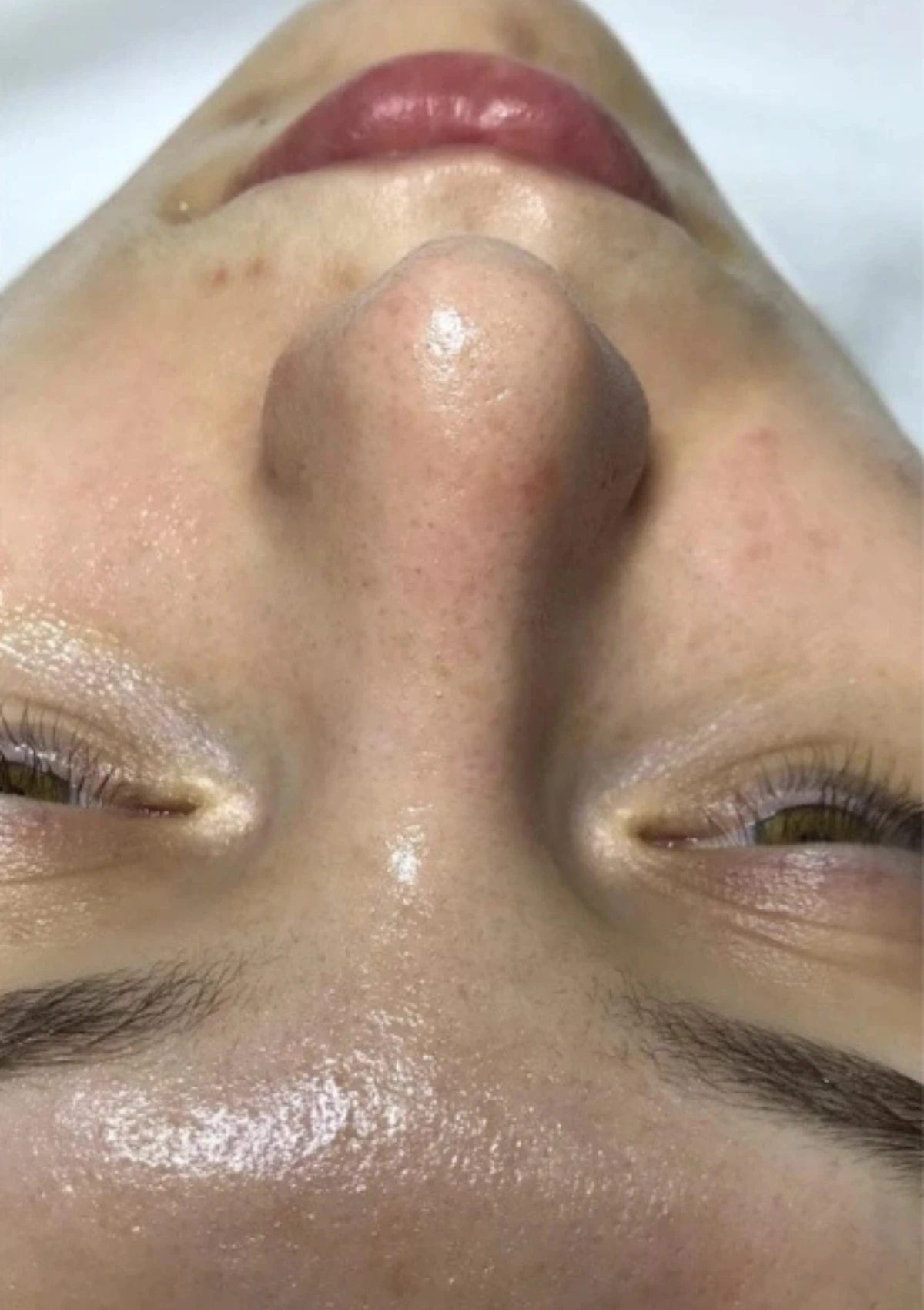 Skóra po zabiegu oczyszczania wodorowego